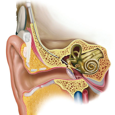耳蜗植入术治疗全聋和重度听力下降