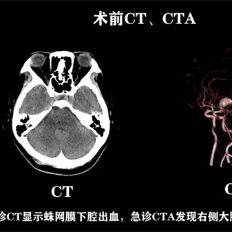 徕卡神刀博览第117期｜专访福医附一院王灯亮：各种流量的血管搭桥如何选择 荧光造影价值何在