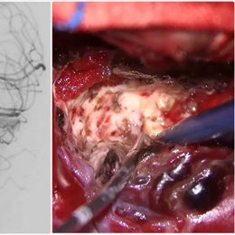 徕卡神刀博览第121期｜专访宣武医院洪韬：创新脑血管畸形一站式治疗模式 疗效与研究成果可期