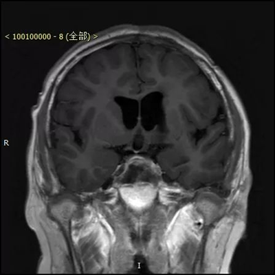 徕卡神刀博览第1期|儿童左额脑室造瘘左侧丘脑肿瘤全切除术一例-北京儿童医院葛明