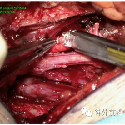 徕卡神刀博览第66期|北医三院刘彬：3D打印硬膜神经根袖加固骶管成形术治疗神经根型骶管囊肿一例